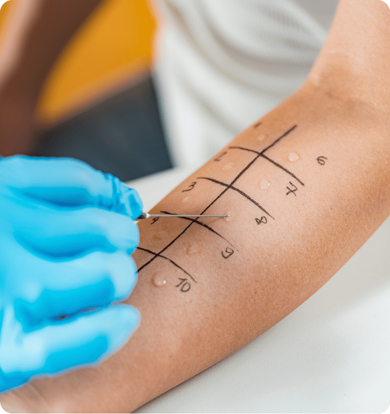 Immunologist Doing Skin Prick Allergy Test on a Child's Arm